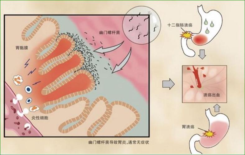 做好这8点,可以预防十二指肠溃疡发作!