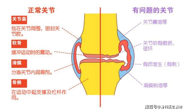 老年人膝关节疼痛应该怎么办?