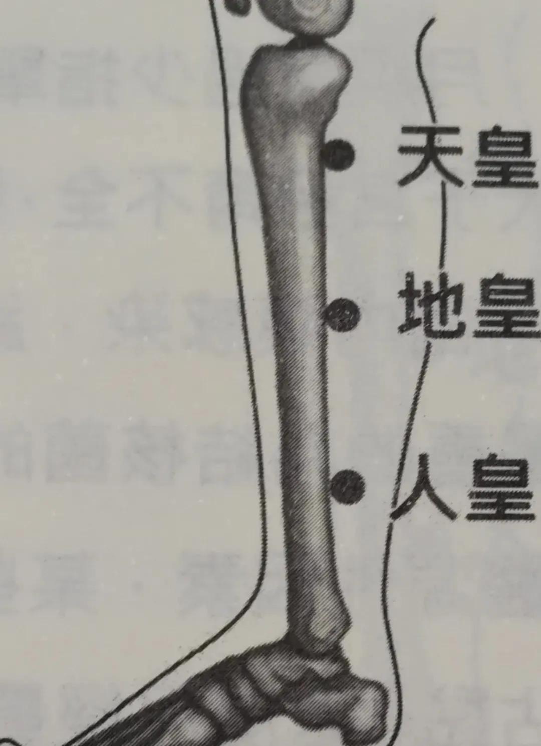 天皇,地皇,人皇三穴合称下三皇,胫骨内侧髁下缘凹陷处直下1寸为天皇