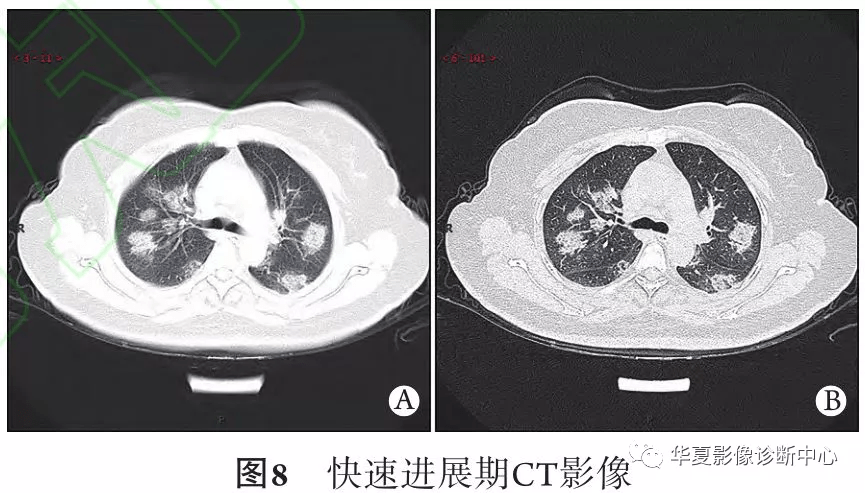 素性渗出,肺泡壁毛细血管充血消退ct影像学表现为多发斑片状实变密度