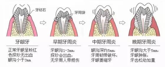 少数侵袭性牙周炎与遗传及系统疾病有关,但其余多数牙周炎基本都是始