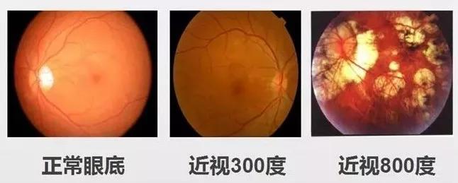 嗨视力科普丨高度近视带来的眼底并发症,晶体植入术和眼激光手术也