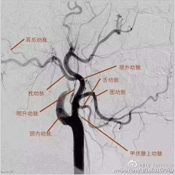 弯曲上行,沿途主要分支有眼动脉,后交通动脉,脉络膜前动脉,末端分出