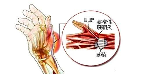 腱鞘炎