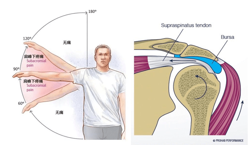 导致在肩上举过程中,肩袖或二头肌腱受到喙肩弓的反复撞击而引起病变