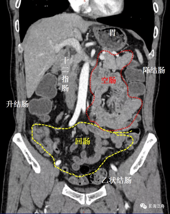 牢记上图腹腔肠管正常解剖位置和特征:空肠位于左上腹,粘膜皱襞丰富