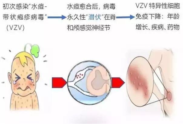 疱疹怎么传染给人 212dfbac04684a50960c87052cbd2d77.jpeg