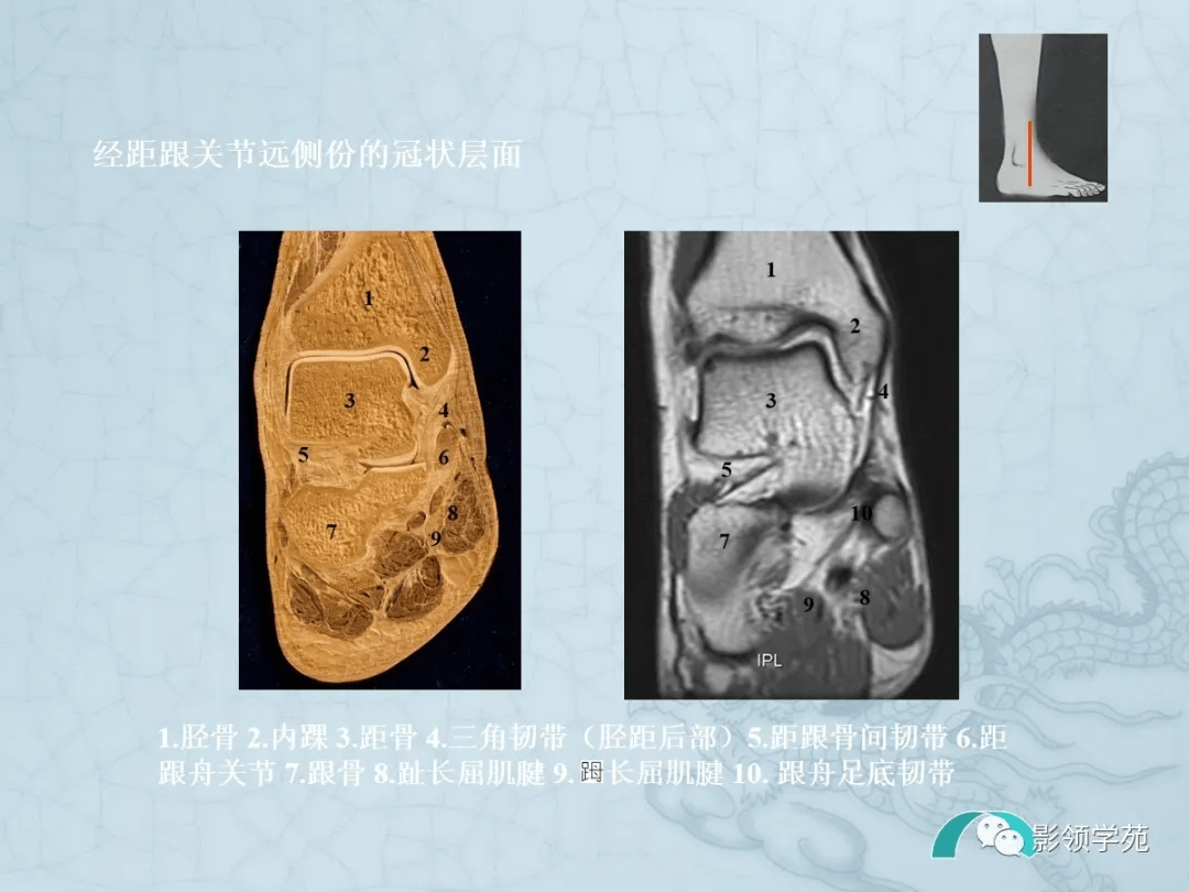 四肢断面解剖及影像