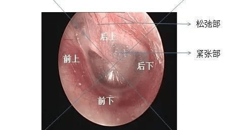 鼓膜穿孔之正常鼓膜是什么样的呢?