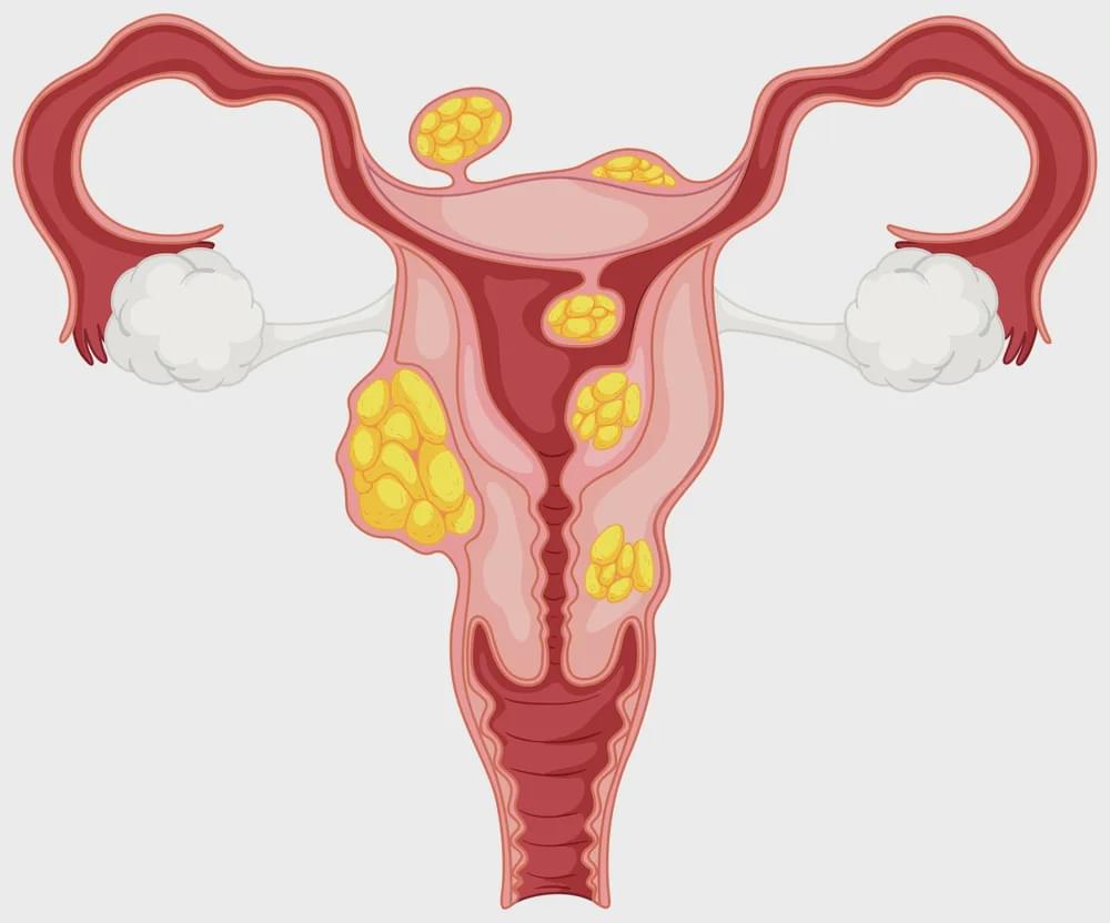 子宫肌瘤最后是不是都会发展成子宫癌?出现5种症状是子宫在求救