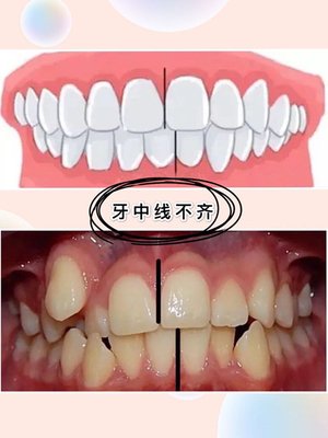 牙齿中线是一条假想的直线,在牙的观察与测量检査工作中,用来描述牙的