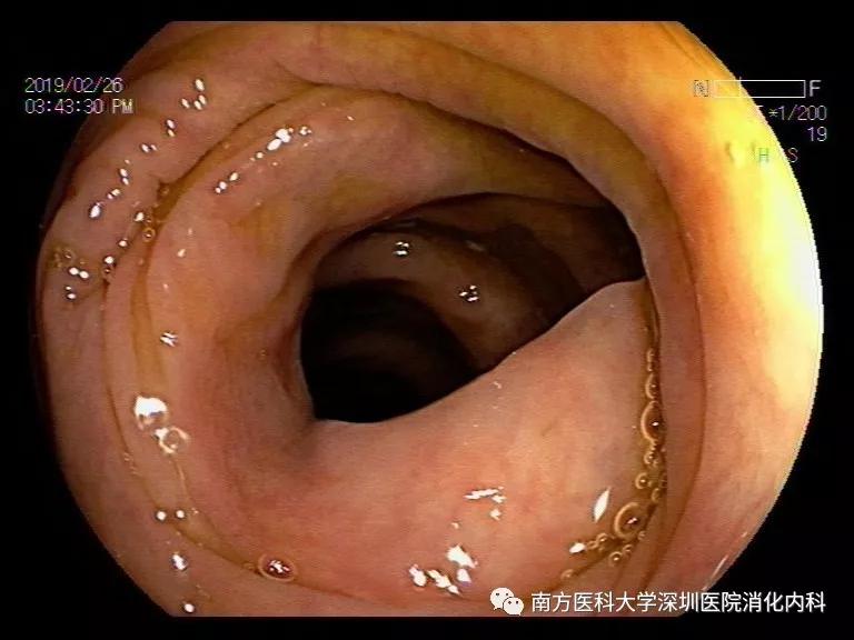 图2小邓治疗后肠镜图片,全大肠粘膜光滑,未见溃疡及糜烂