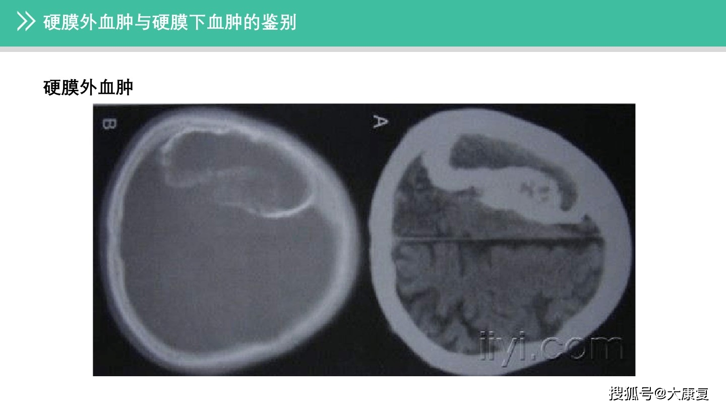 硬膜外血肿与硬膜下血肿的鉴别]