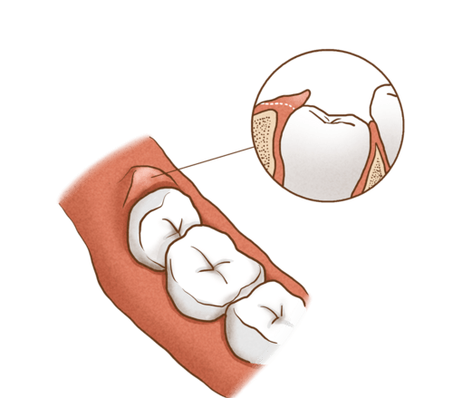 碰上智齿冠周炎该怎么办?