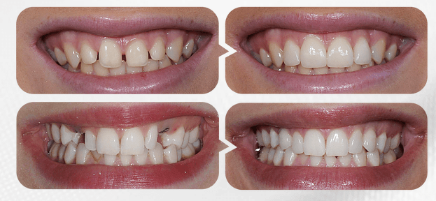 爱迪特全瓷牙修复前后对比图看了这些,是不是对爱迪特全瓷牙有了简单