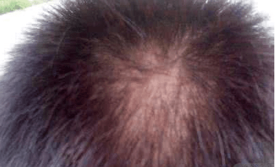 小孩掉头发是什么原因引起的与头皮癣密切相关