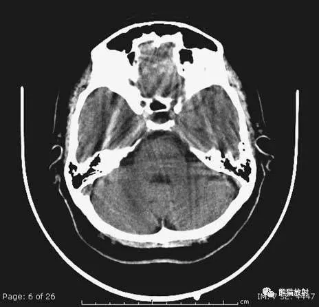简明又详细的头部ct读片详解,收藏!