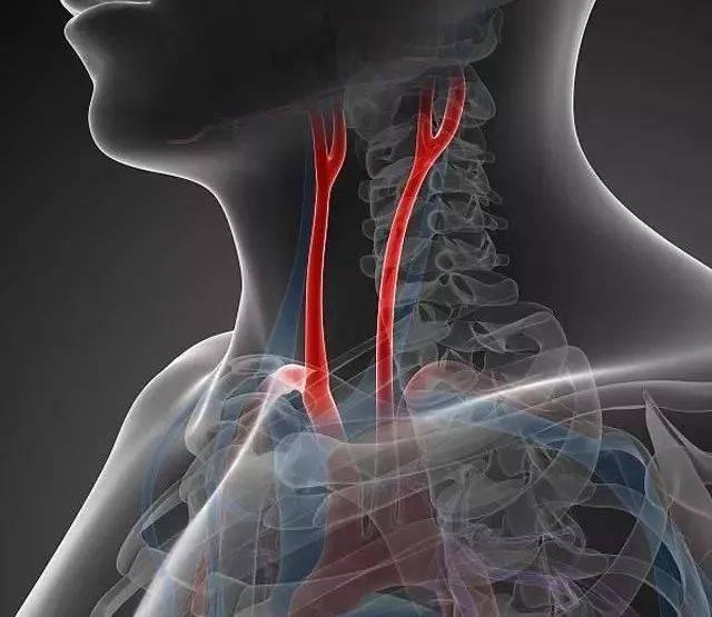 颈动脉有了斑块对哪里影响最大有了斑块后要注意什么来看看