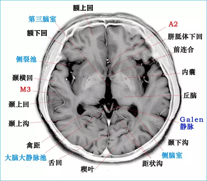 利用t2wi反相图学习高清颅脑断层解剖