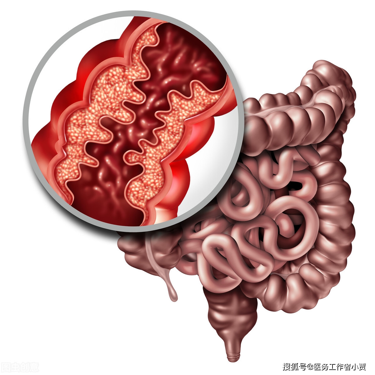 最后是血运性肠梗阻,这类患者主要是由于肠系膜血管发生血栓或是栓塞