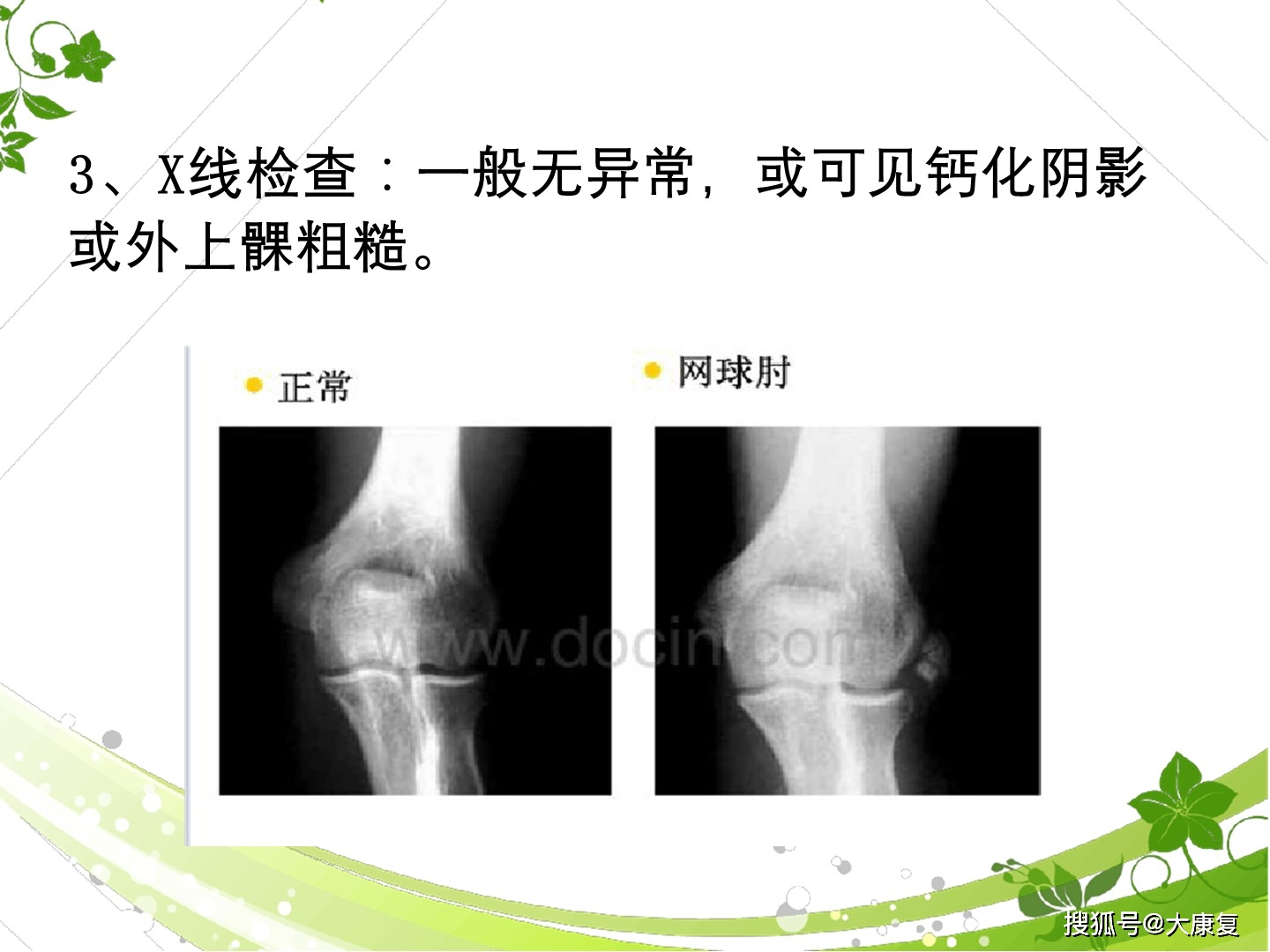 肱骨外上髁炎