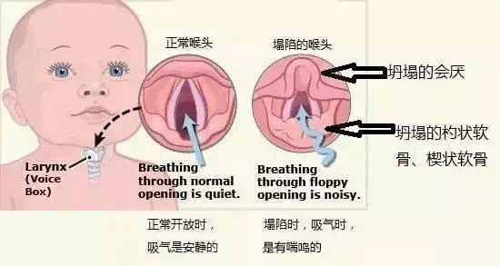 在婴儿喉软组织中,声带上方的部分紧密卷曲,杓状会厌带将前面的会厌