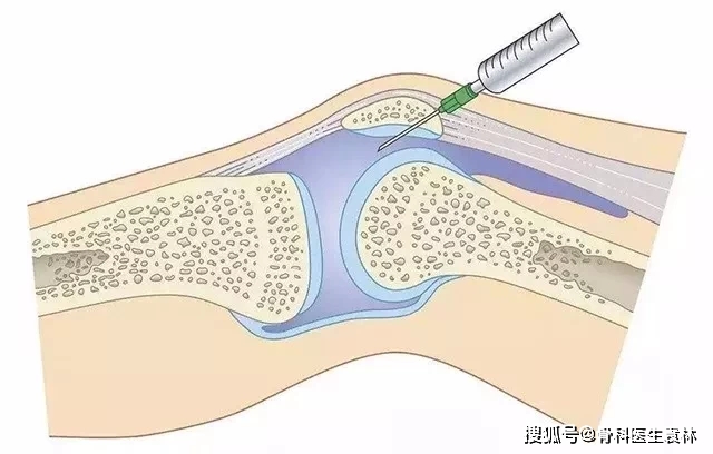 而是关节积液增多,所以注射玻璃酸钠对滑膜炎的治疗意义不大,而且容易