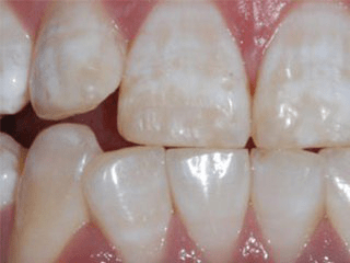 氟斑牙顾名思义就是摄入过多的氟导致的牙釉质发育不全,氟斑牙一般在