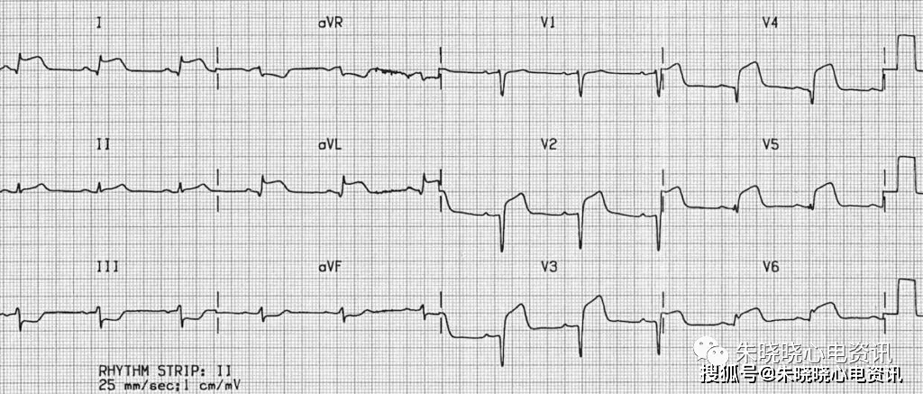 心肌缺血的心电图表现