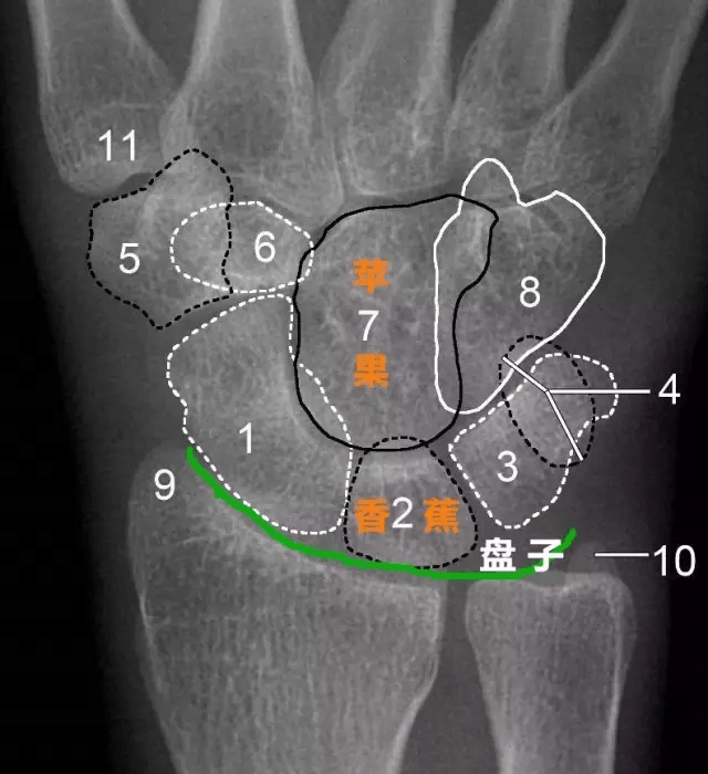 一文读懂腕关节x线阅片技巧:影像医生千万别漏诊!_桡骨