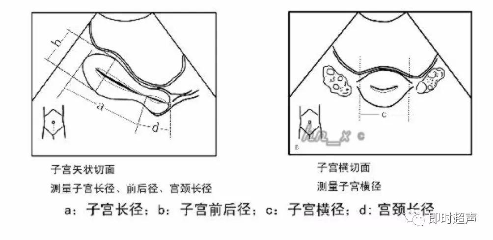 图2-1-11 子宫测量方法示意图