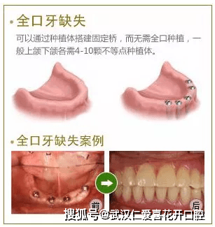 全口缺失牙,全口即刻修复种植牙技术