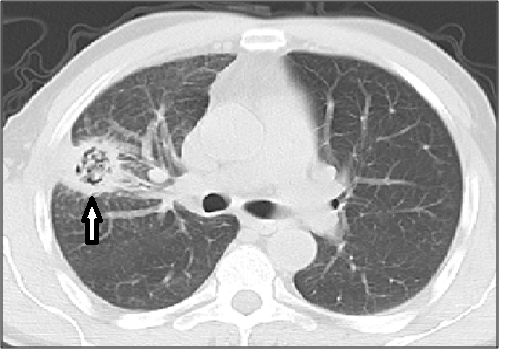 4种类型的肺曲霉菌病影像表现