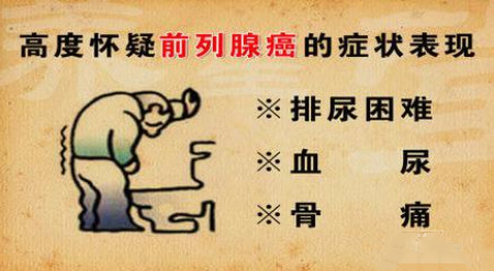 前列腺癌临床分期有四期,早期症状不明显,中晚期才有腰酸,尿痛,尿急等