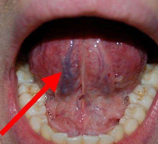 舌头下有"青筋"突出,示意身体哪里有问题?_血瘀