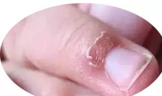 倒刺通常会出现在我们的手指上,尤其是指甲周围的皮肤.