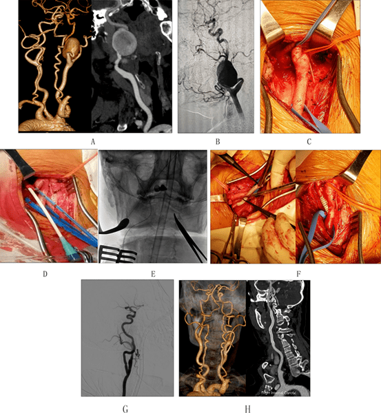 j stroke cereb d.近颅底颈内动脉瘤治疗的单中心经验@血管资讯