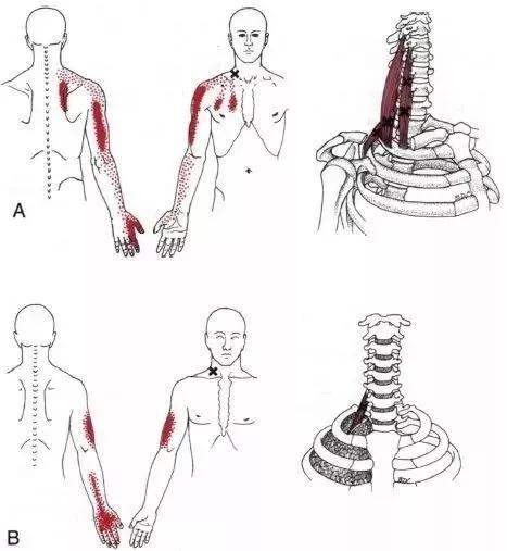 干货| 斜角肌激痛点-上半身疼痛的解决关键