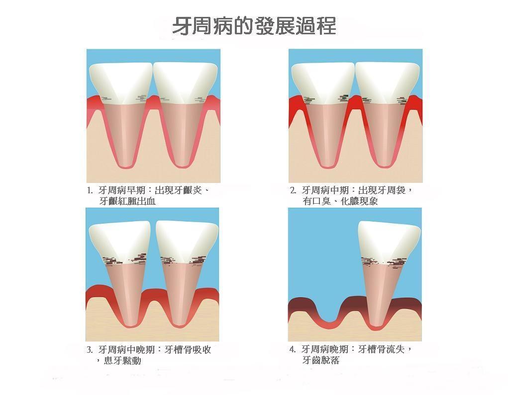 什么是牙周病?