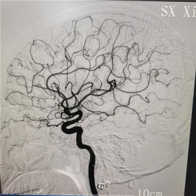 "小"手术"大"疗效 航天城院区成功开展全脑血管造影术