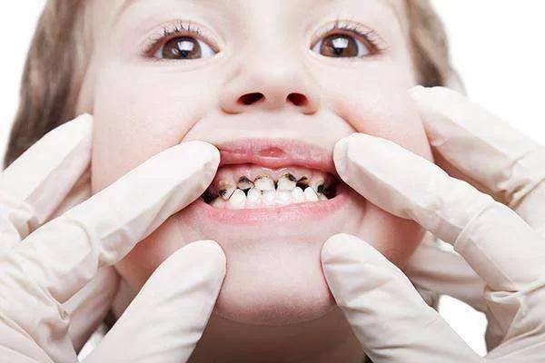 预防大于治疗|植得口腔儿牙医生建议,儿童龋齿早预防早治疗_牙齿