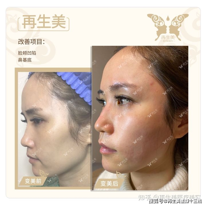 上海再生美医疗美容医院案例分享