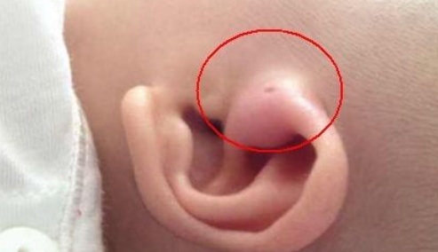 原创宝宝耳朵上有这种洞是富贵命?处理不当却会有严重后果
