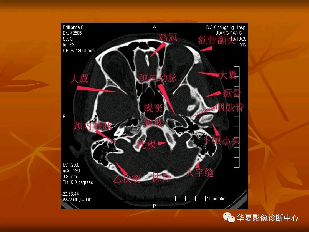 颅底ct高清图解 常见骨折部位图示