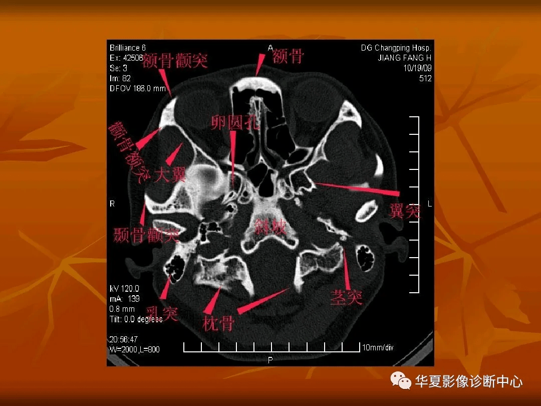 颅底ct高清图解 常见骨折部位图示