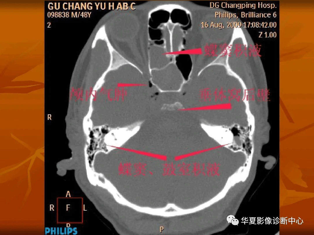 颅底ct高清图解 常见骨折部位图示