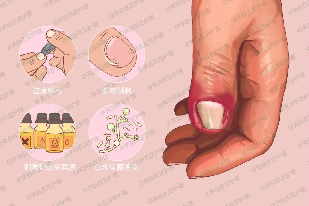 芙自在 | 甲沟炎都有哪些表现症状?