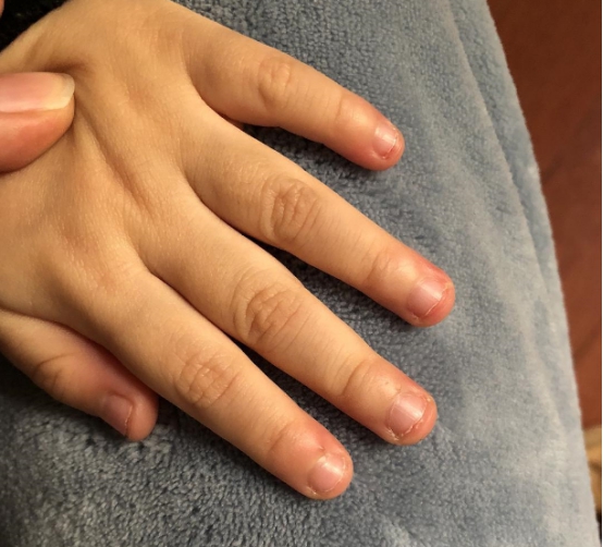 孩子有咬手指的行为会有什么危害,要如何才能预防?