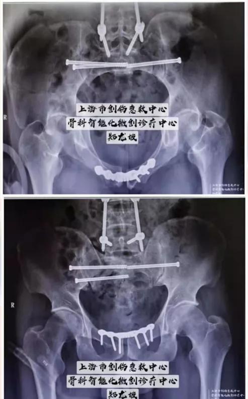 男子多发骨折病情危重,上海十院骨科智能化微创手术助