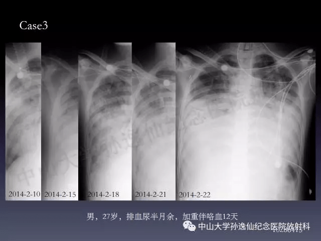 肺出血的影像学特征